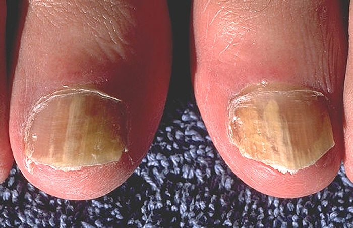 Fungal nail infection affecting both great toenails, thickened and discoloured