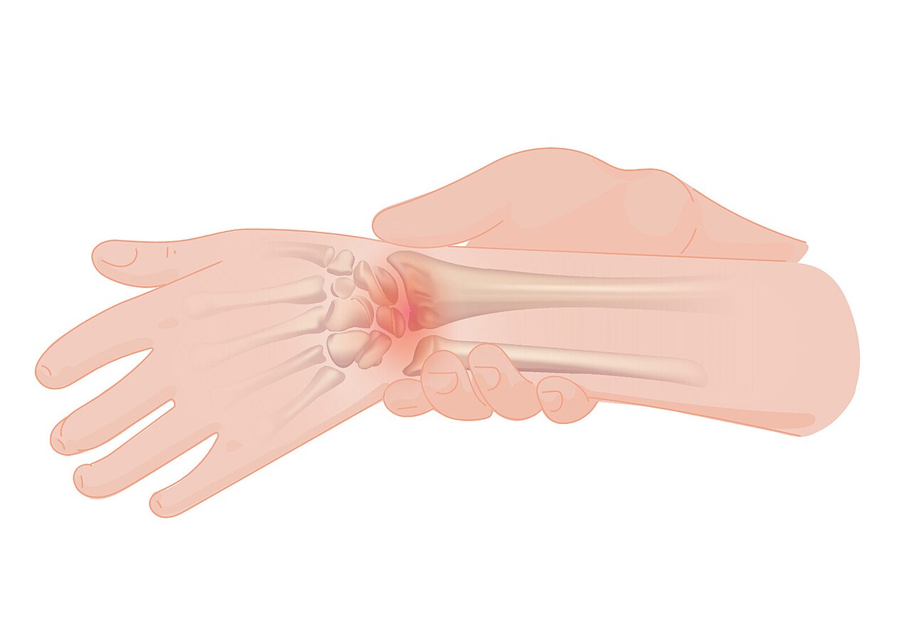 An illustration of wrist pain.